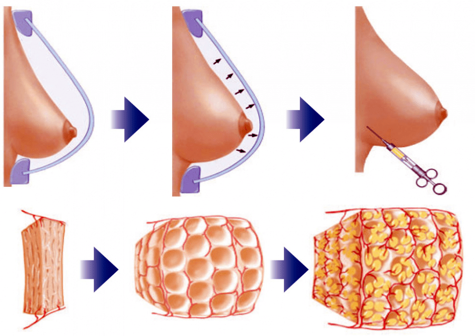 Pag-opera sa Breast