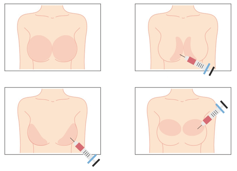 Mga lugar alang sa indeyksiyon sa hyaluronic acid sa dughan