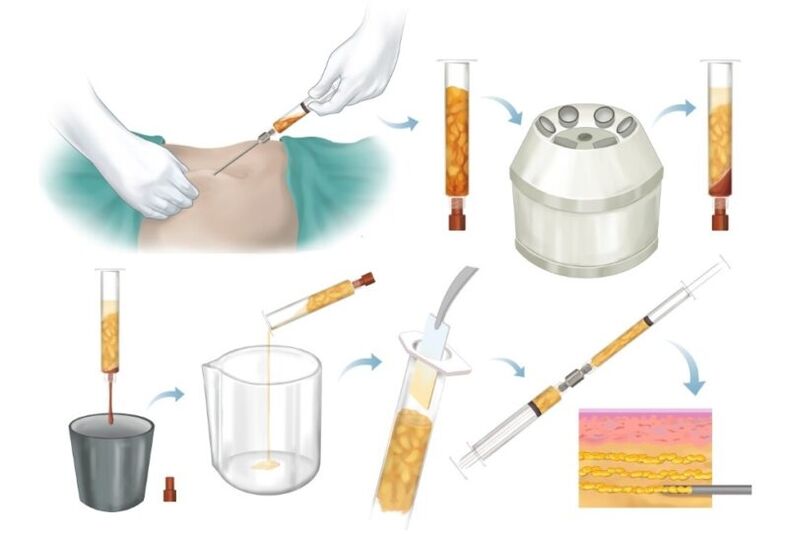 Pagtangtang sa tambok gikan sa mga lugar nga problema, pagproseso ug pag-injection sa tisyu sa dughan