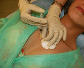 Pasiuna sa Meso-Cocktail sa stock tissue - usa ka kapilian sa hyaluronic acid injections