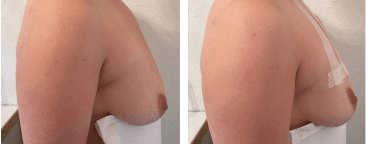 Sa wala pa ug pagkahuman sa pagbayaw sa dughan