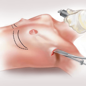 Endoscopic dughan pagdugang