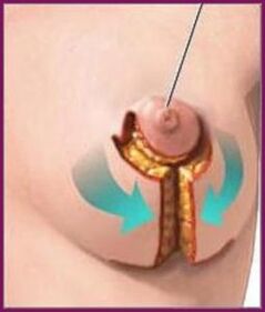 Periareolar implantation sa suso