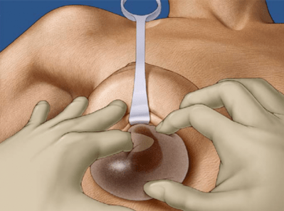 Submammary pagsulud sa implant sa suso